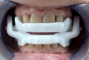 formula antironquidos almería